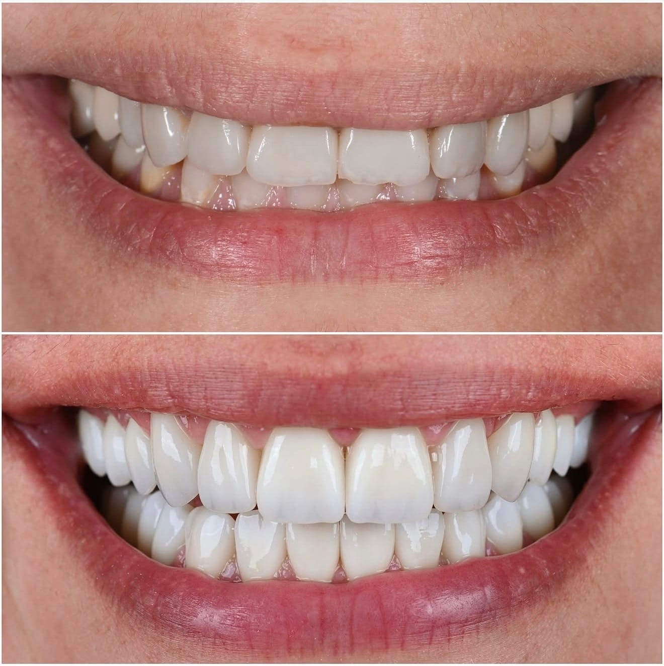 Before & After Smile Gallery | ACE DNTL Porcelain Veneers Marbella