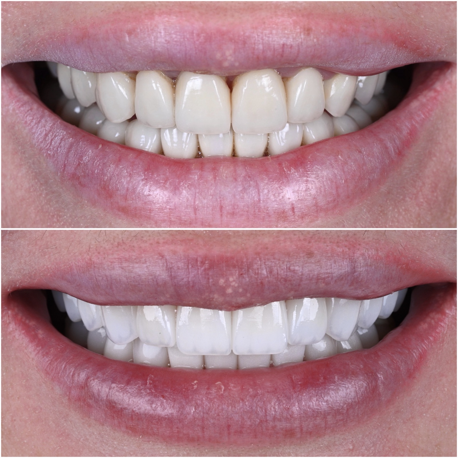 Before and after porcelain veneers by ACE DNTL STUDIO — uneven front teeth transformed into a uniform natural smile