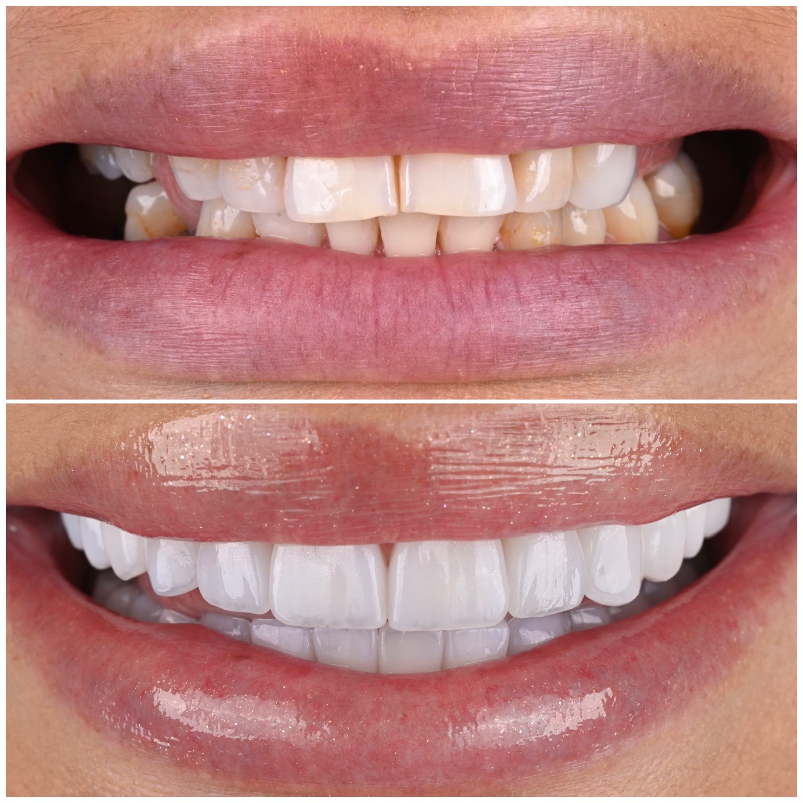 Before and after full smile transformation at ACE DNTL STUDIO — worn stained teeth restored to a bright natural arch