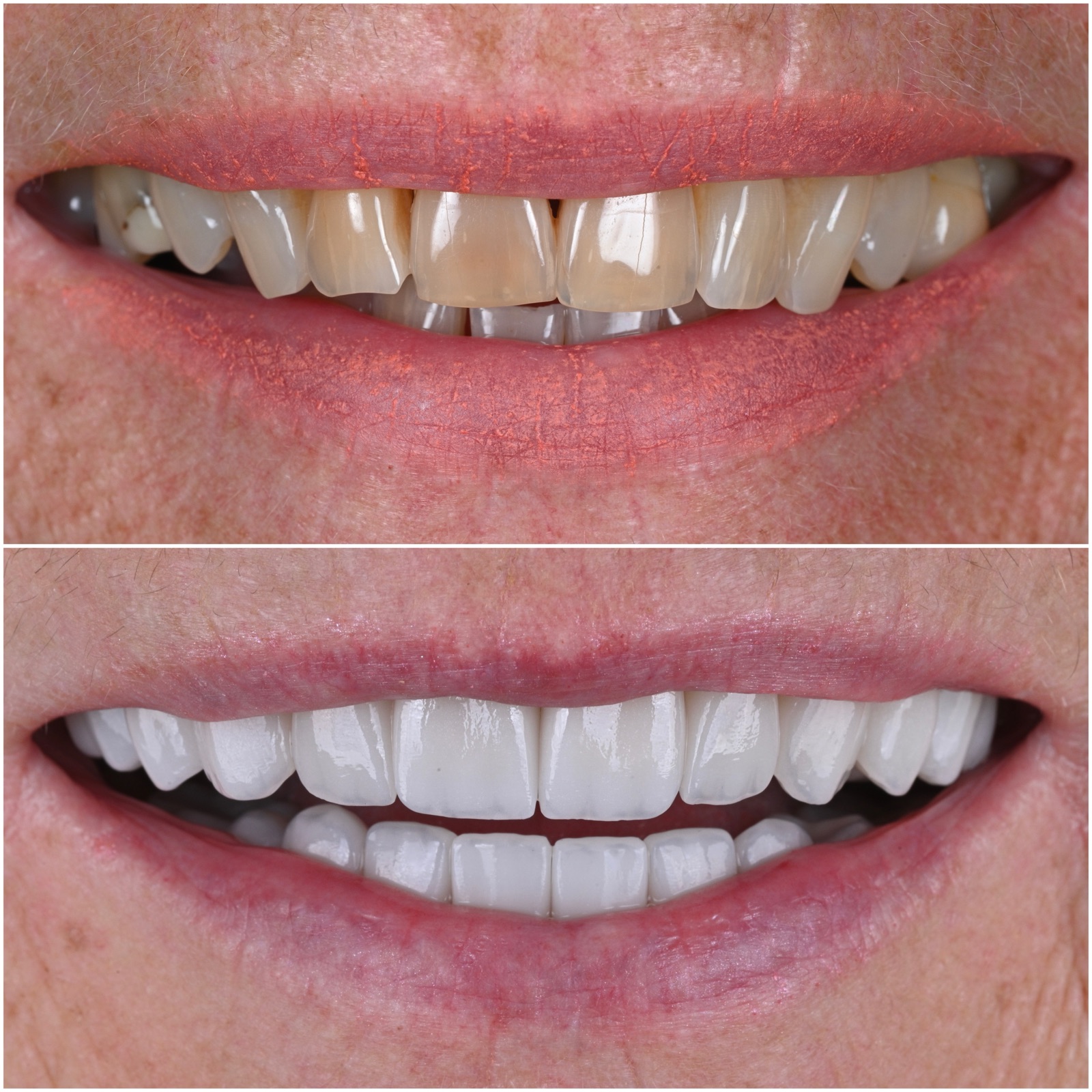 Before and after at ACE DNTL STUDIO — damaged and stained teeth completely restored, proof it is not too late