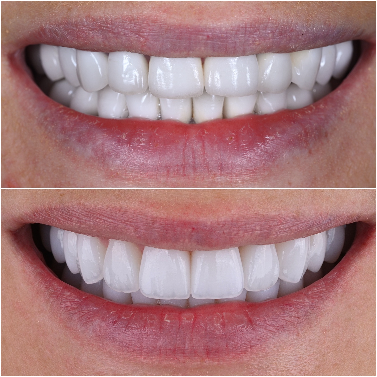 Subtle before and after smile refinement by ACE DNTL STUDIO — natural teeth perfected, not replaced