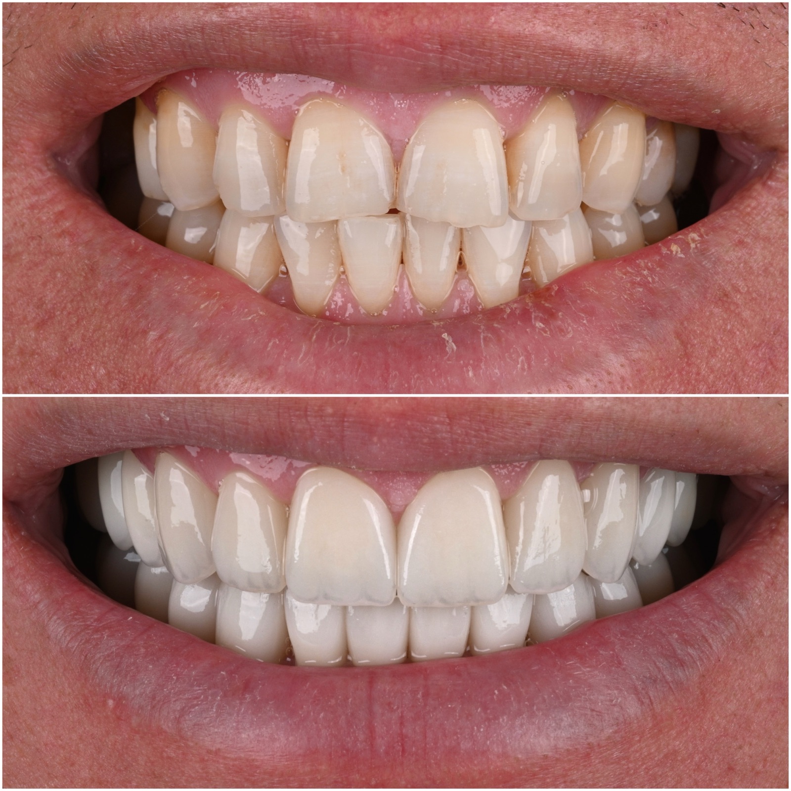 Before and after — age-yellowed worn teeth restored to a natural smile at ACE DNTL STUDIO
