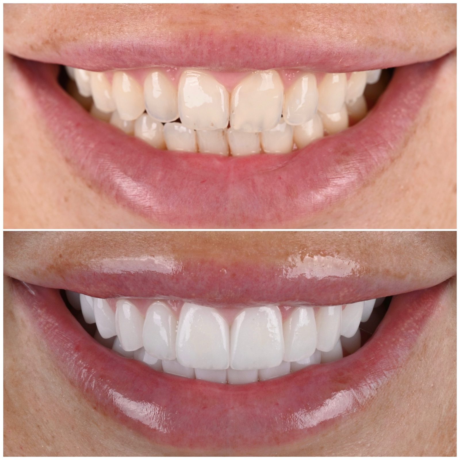Before and after smile rejuvenation at ACE DNTL STUDIO — age-related yellowing reversed