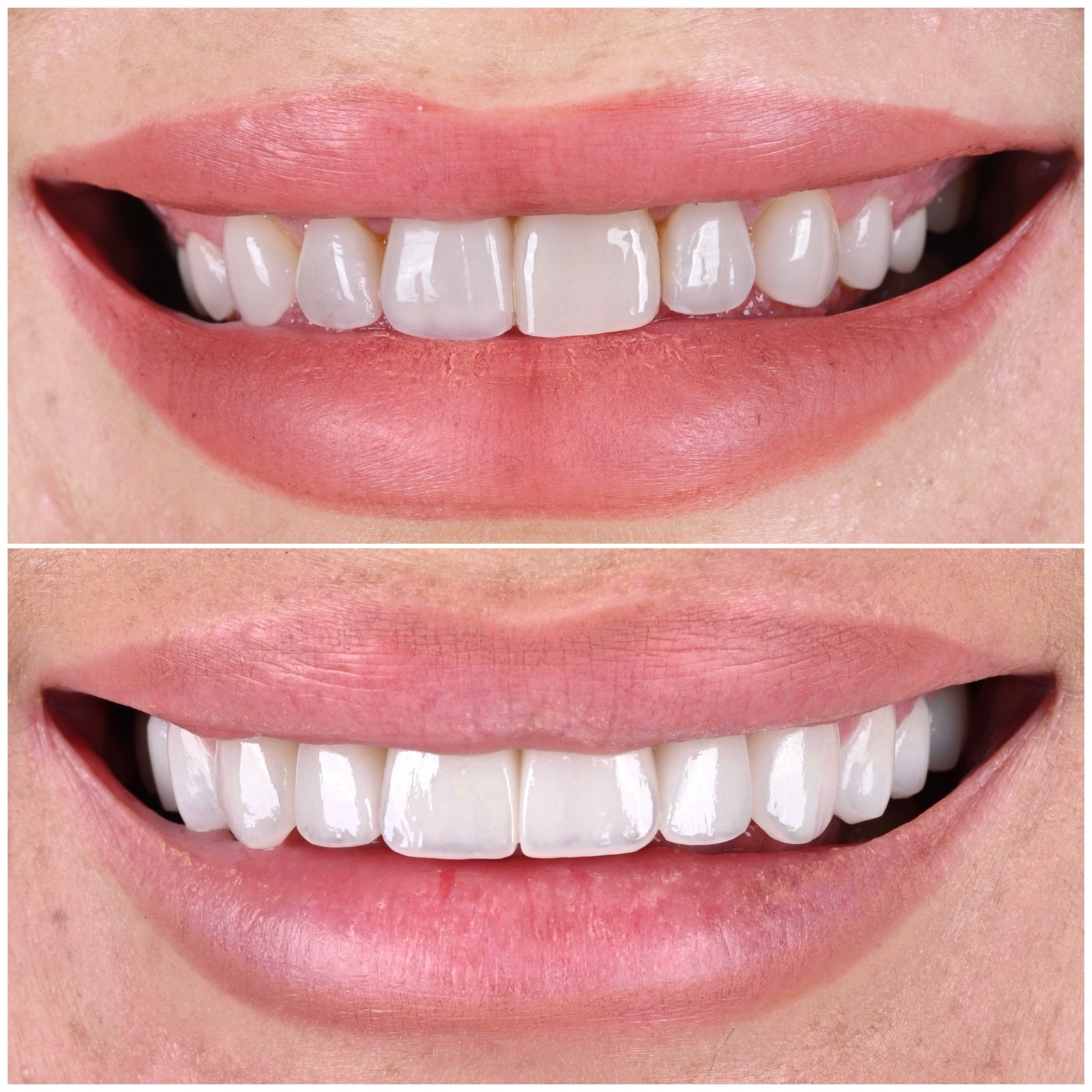 Natural before and after veneer result by ACE DNTL STUDIO — a smile that still looks like you