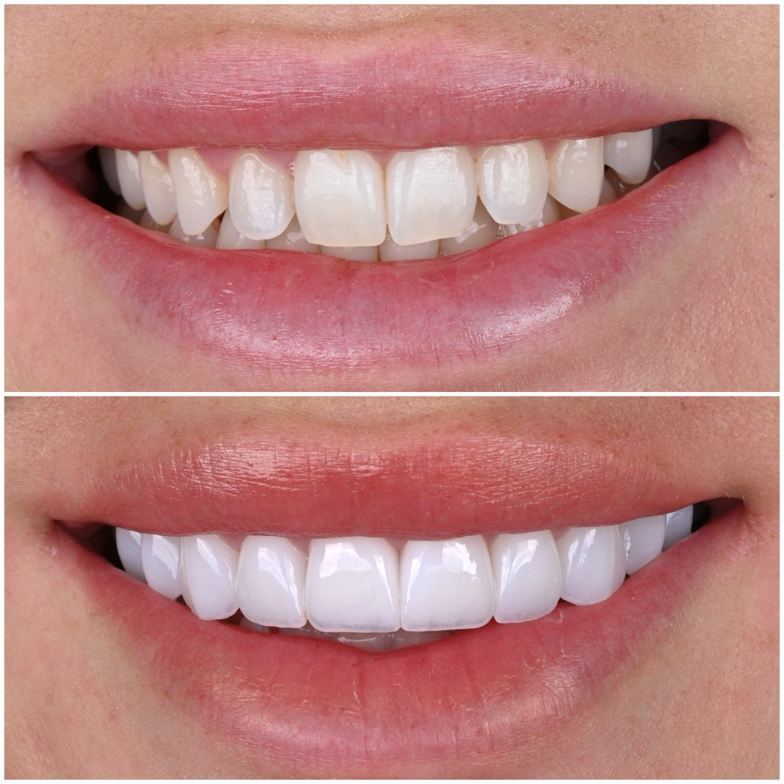 Before and after — stained uneven teeth transformed at ACE DNTL STUDIO