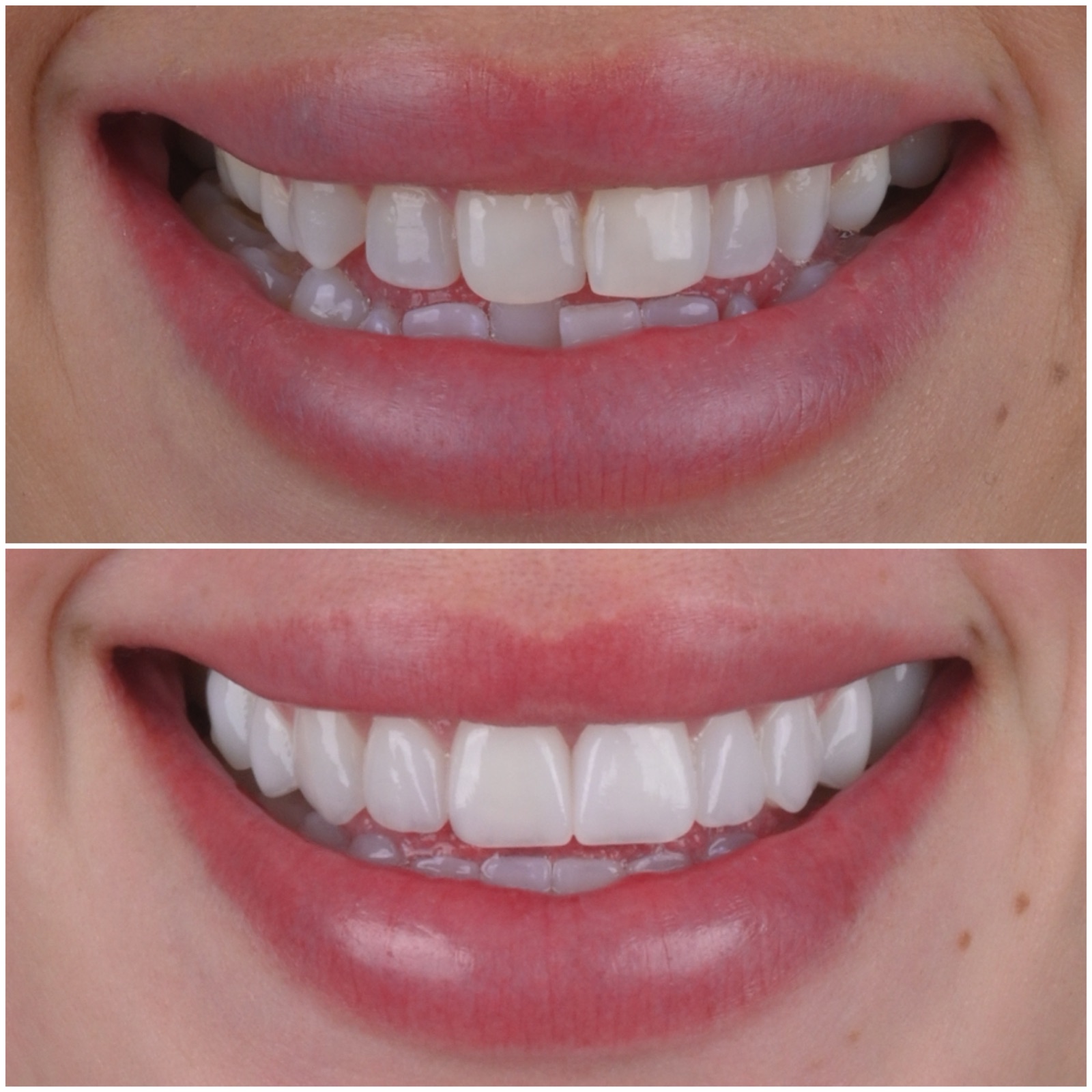 Subtle smile transformation before and after at ACE DNTL STUDIO
