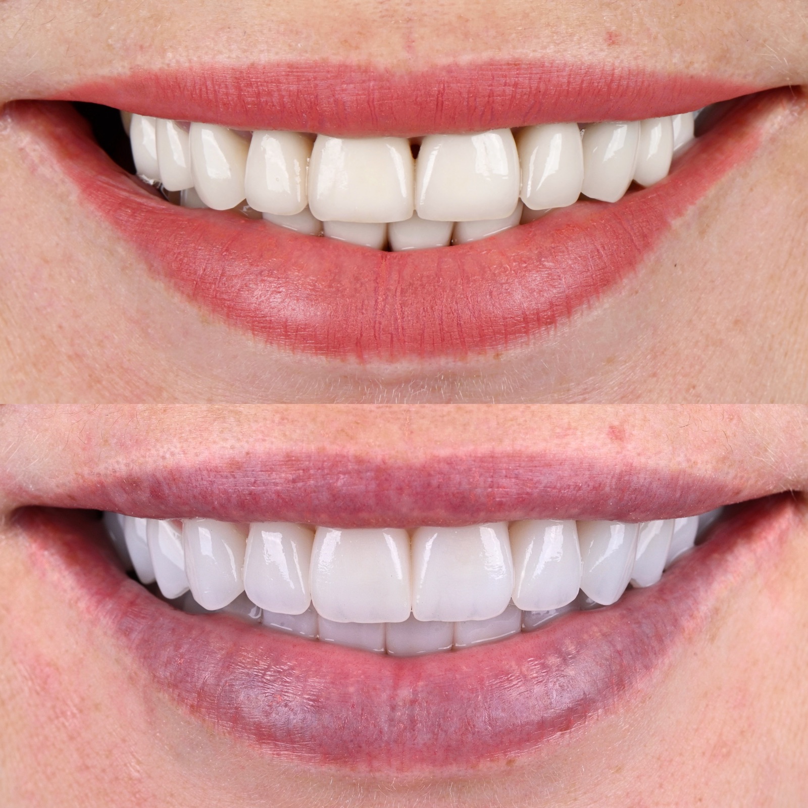 Before and after elective smile refinement by ACE DNTL STUDIO