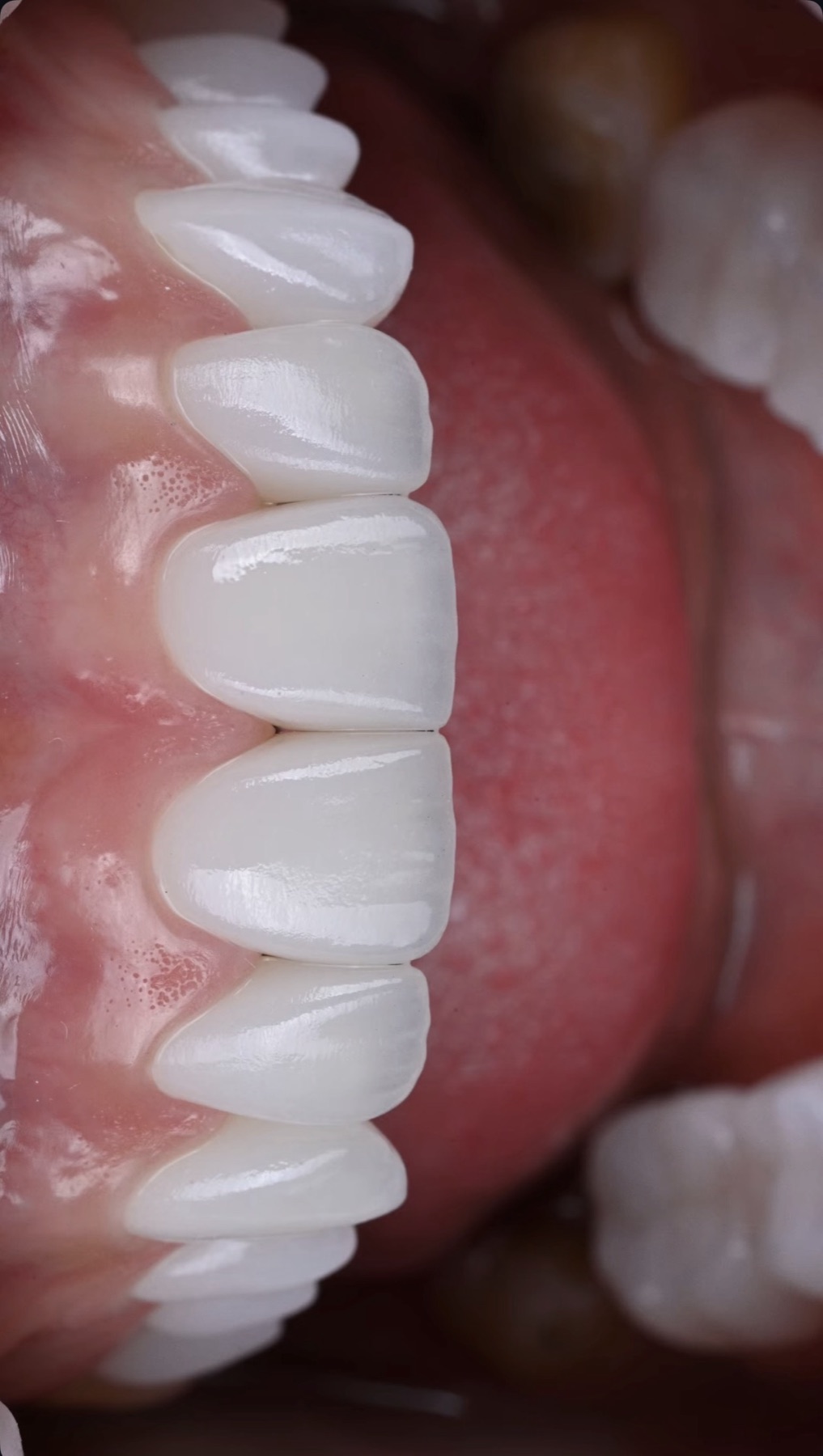 Close-up of healthy pink gums around hand-finished ACE DNTL Veneer work