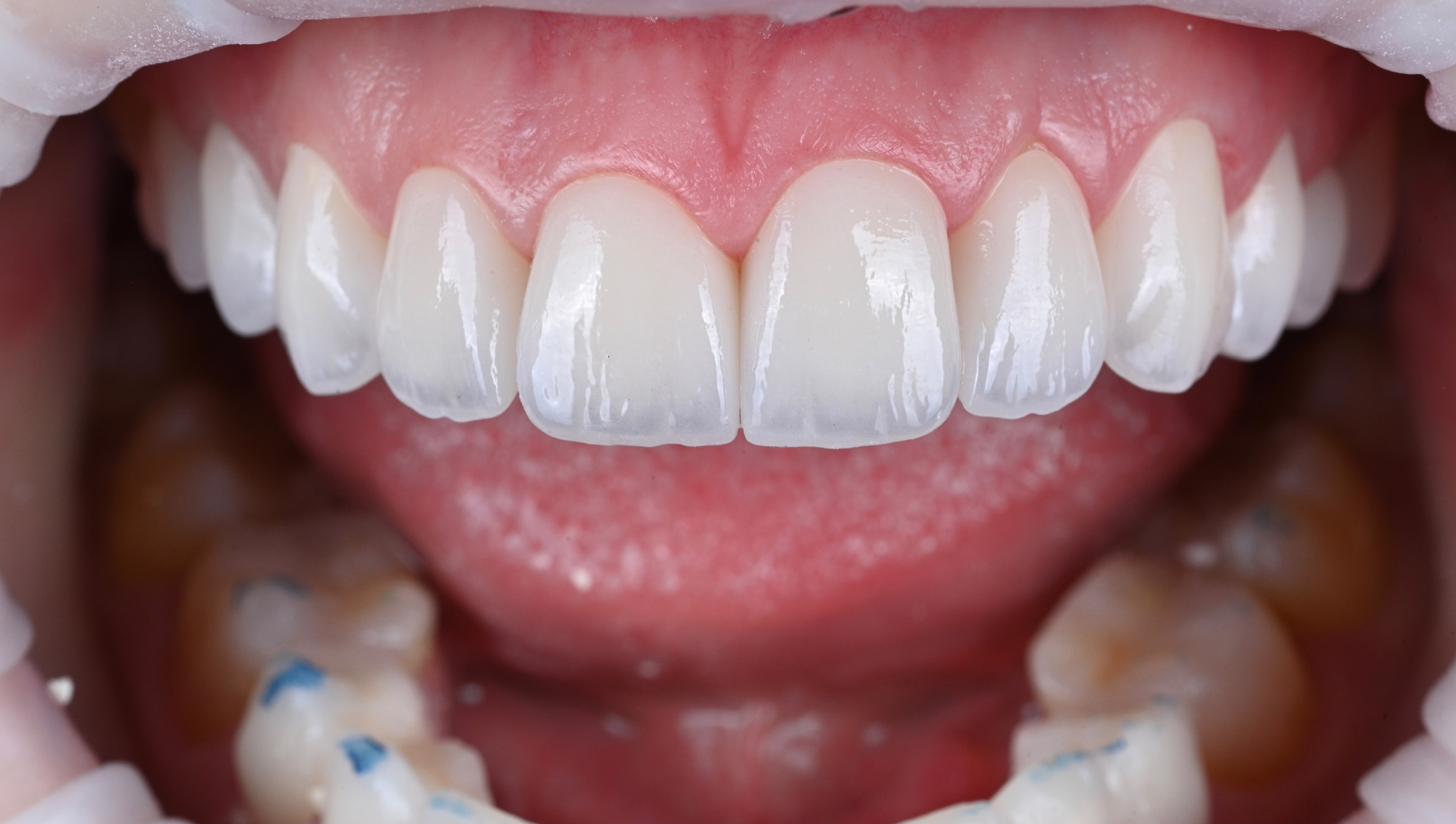 The ACE DNTL Veneer by ACE DNTL STUDIO - finished upper arch in hand-finished Prettau P4 zirconia, Marbella