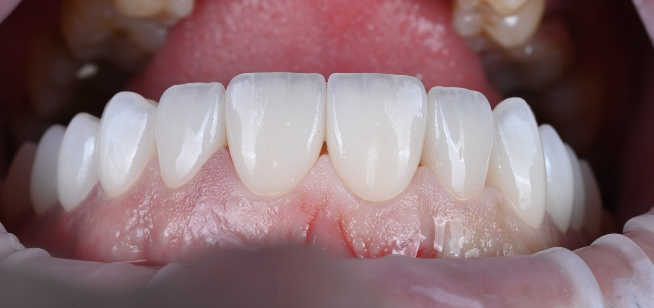 ACE DNTL Veneer — lower arch