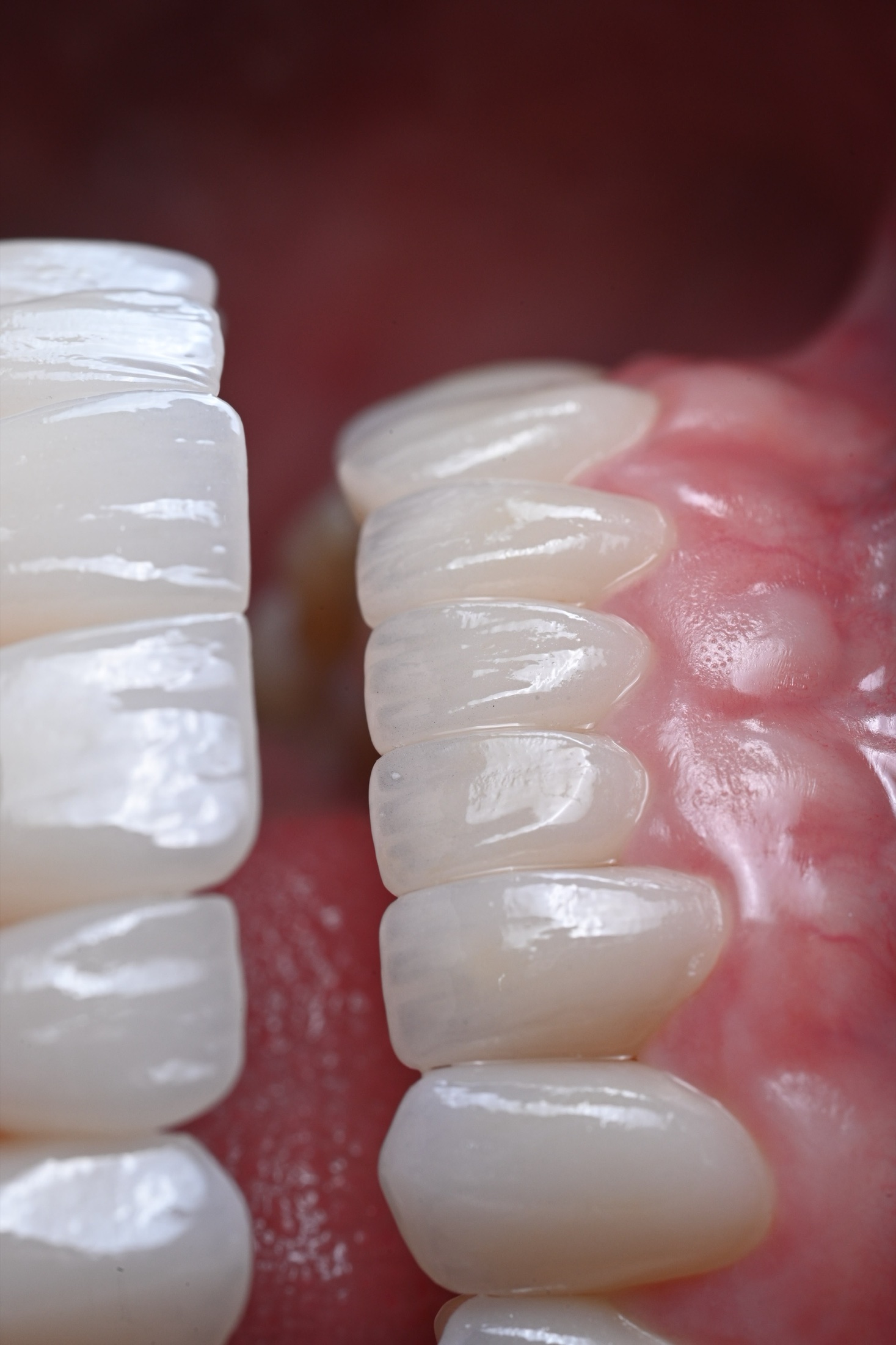 Side profile of a full ACE DNTL Veneer arch, hand-painted for 3D depth