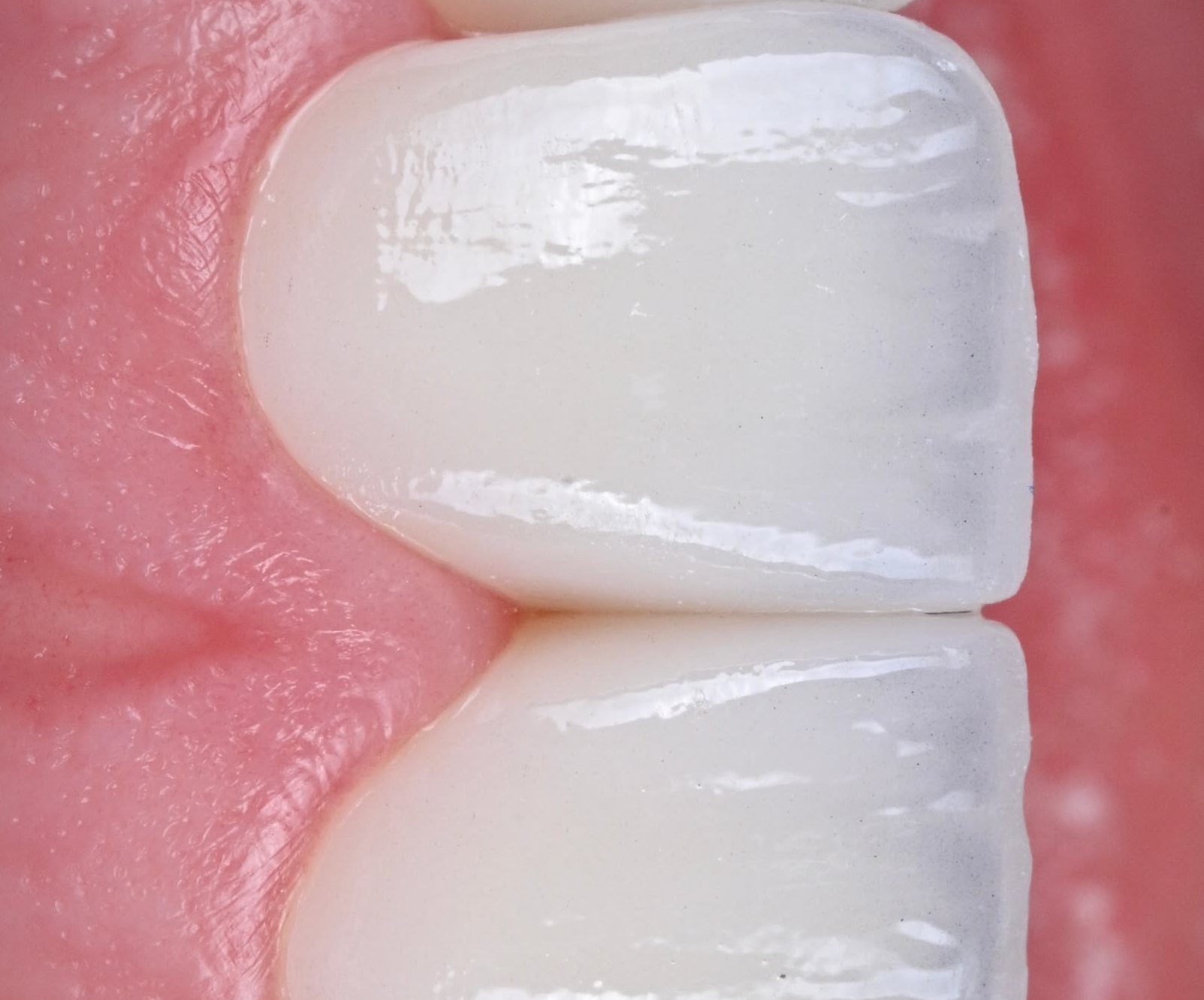 ACE DNTL Veneer — hand-polished surface in extreme detail