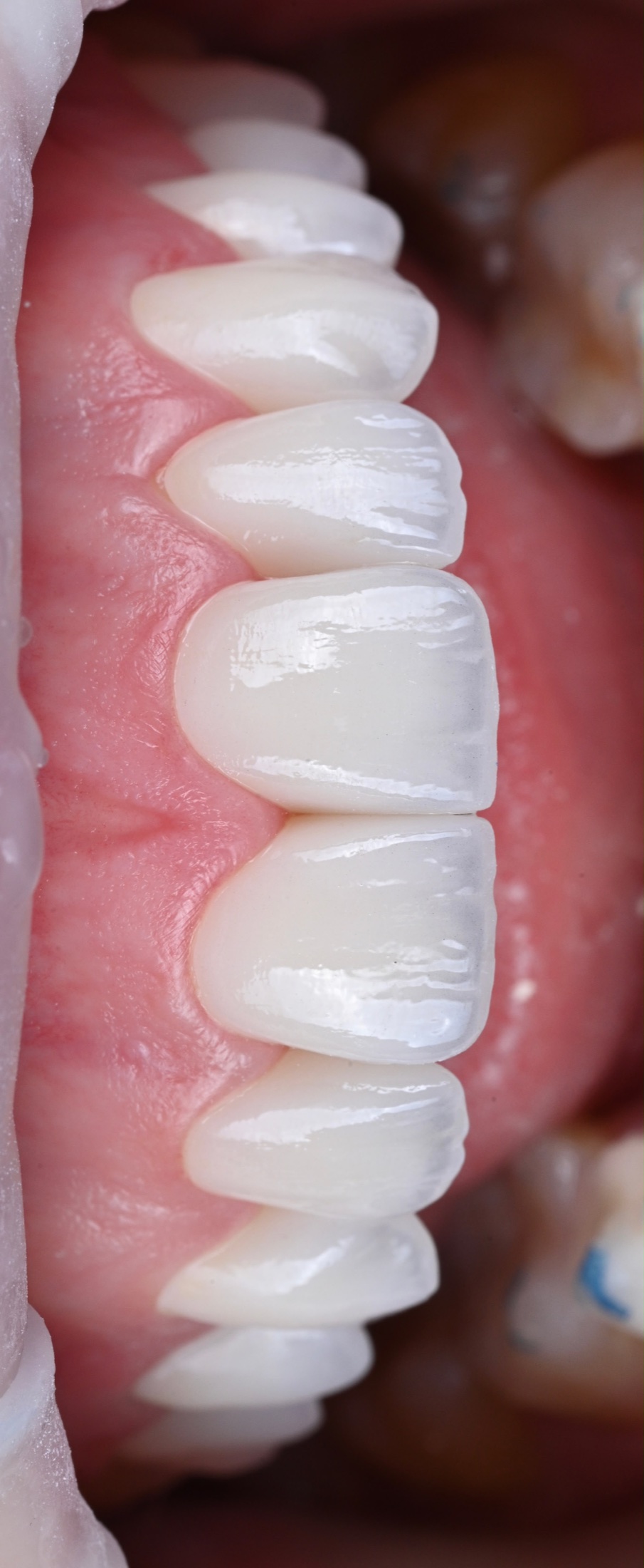 The ACE DNTL Veneer in macro — hand-layered Prettau P4 zirconia by ACE DNTL STUDIO, Marbella