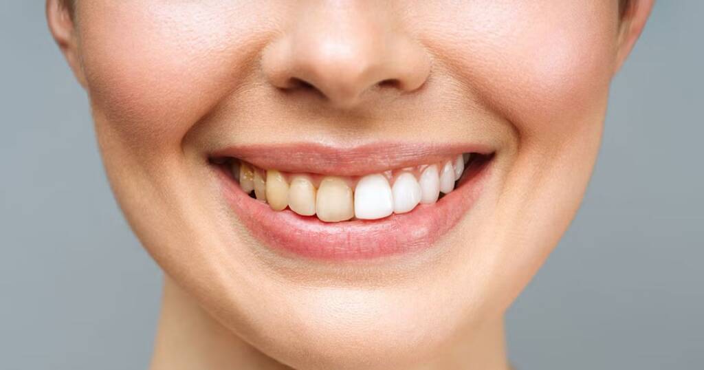 Why Soda Stains Teeth