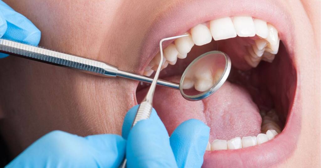 Gumline Decay