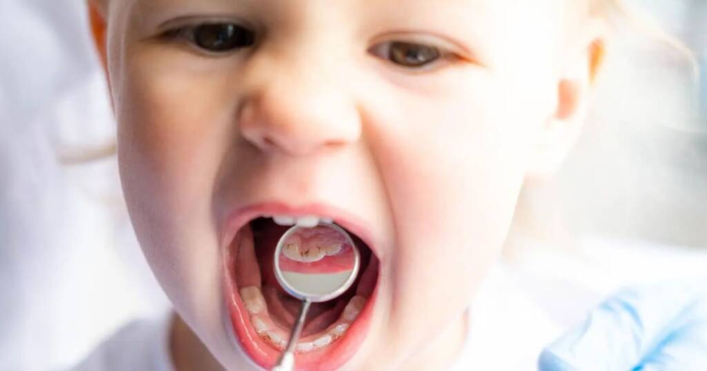 Prevent Gumline Decay