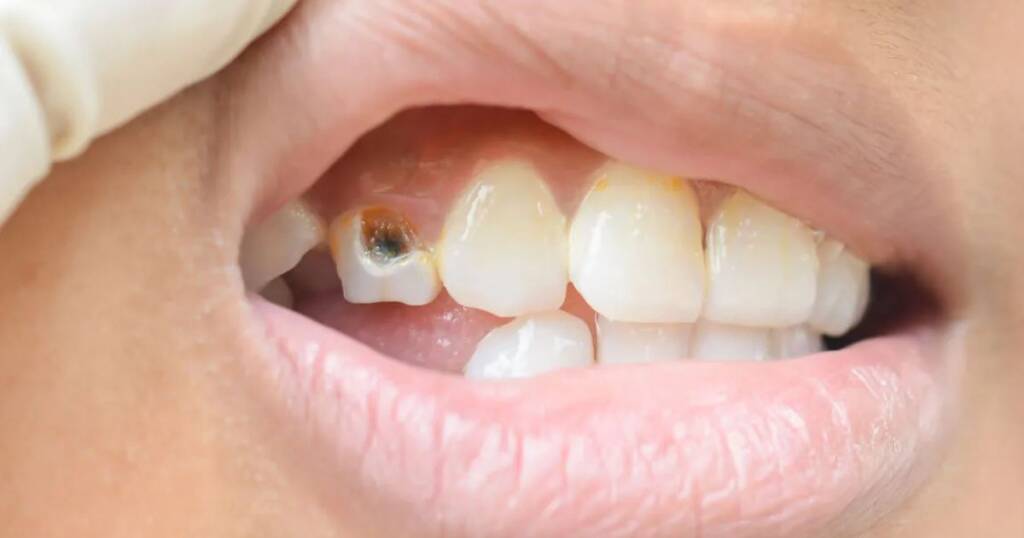 Gumline Decay