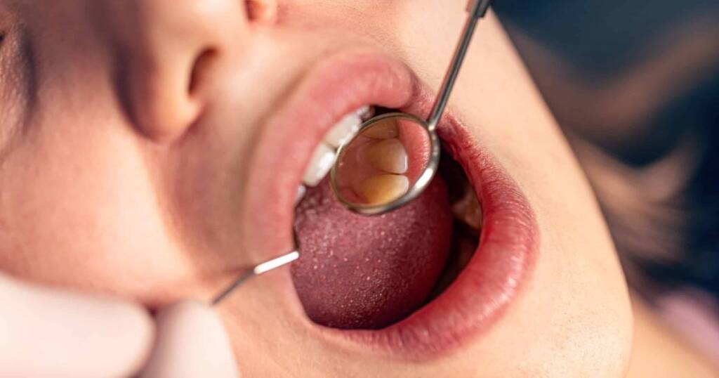 Gumline Decay