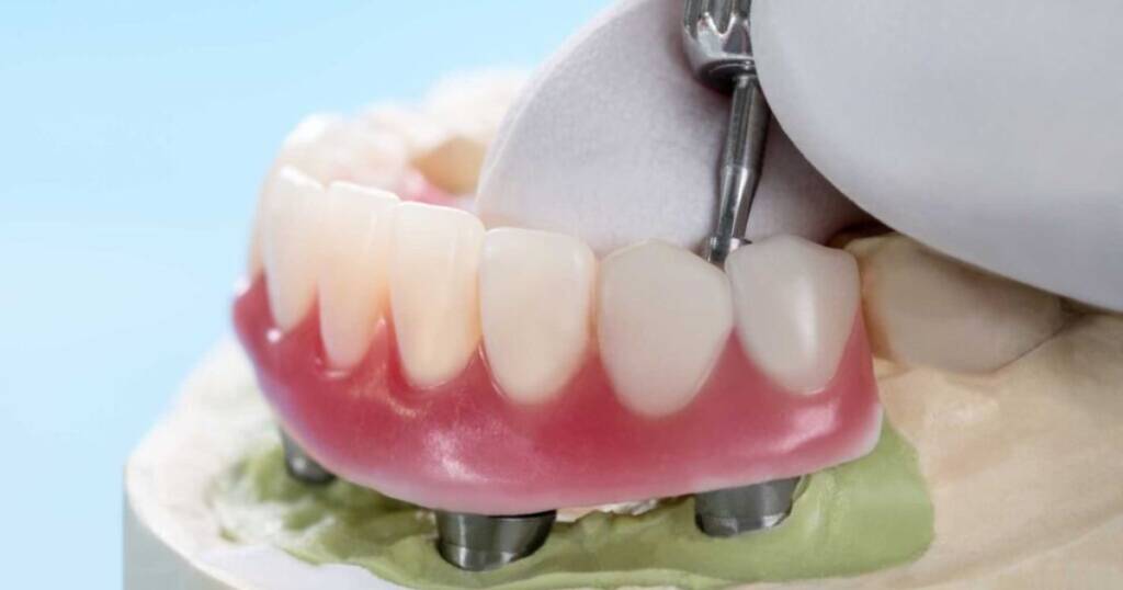 Implant Overdentures Risks and Disadvantages