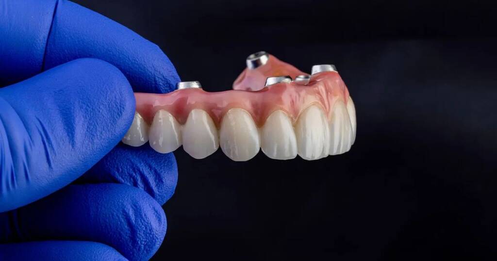 How to Clean Implant Retained Overdentures