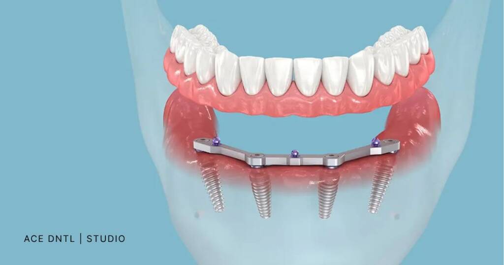 Implant Overdentures Advantages