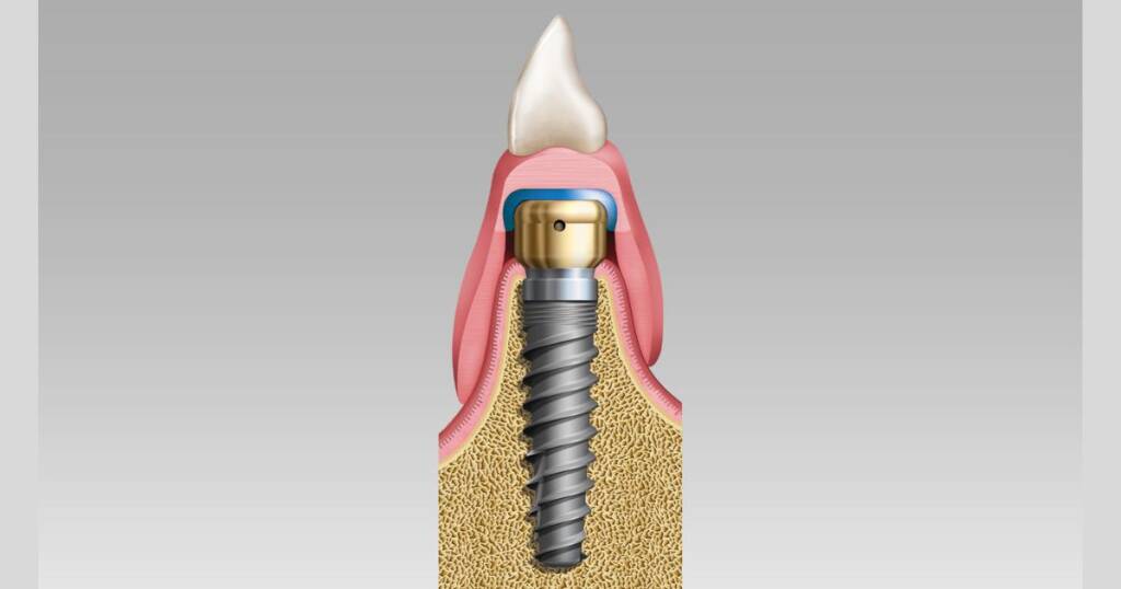 Implant Overdentures vs Traditional Dentures Comparison