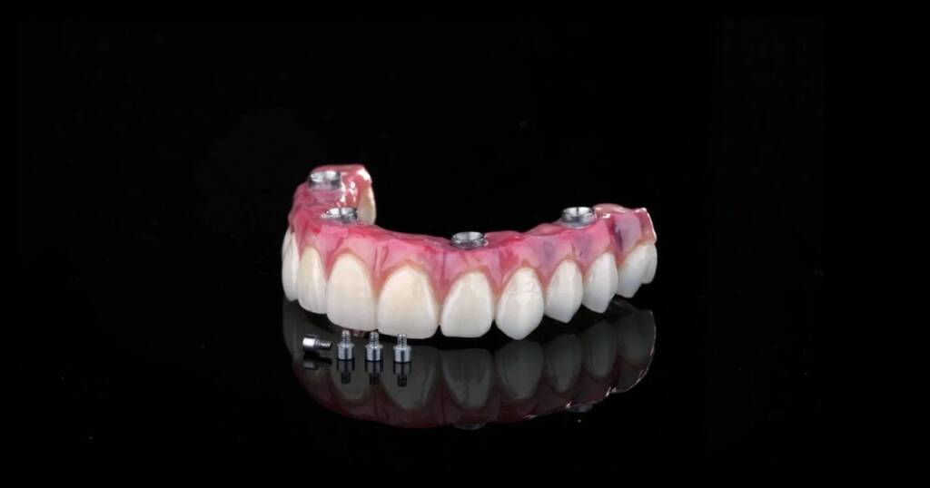 Types of Implant Supported Overdenture