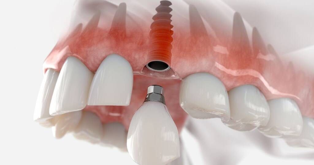 Implant Overdentures Treatment Step by Step