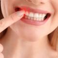 Gumline Cavity: Causes, Early Signs, Treatment and Prevention.