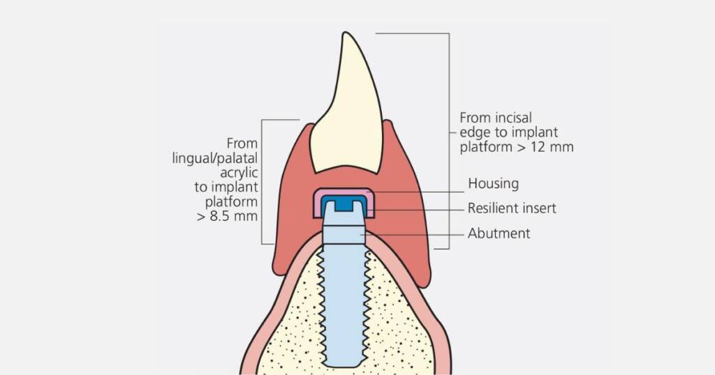 Implant Overdentures