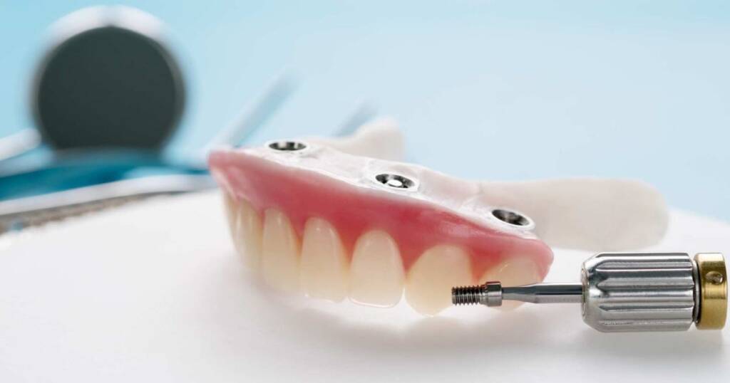 Implant Overdentures
